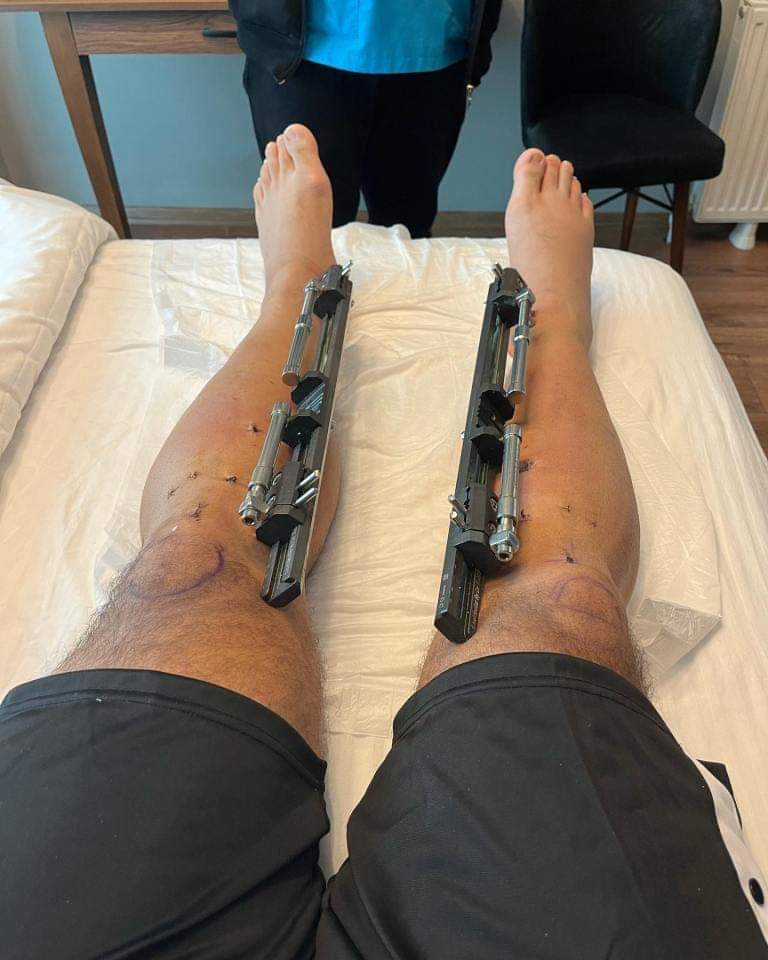 Man spends N49m on surgery to grow 7 inches taller