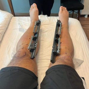 Man spends N49m on surgery to grow 7 inches taller