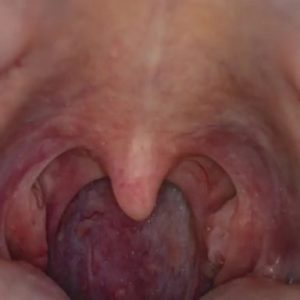 Oral sex, HPV, cause of rising throat cancer cases – Experts