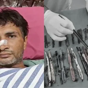 Surgeons remove 29 spoons, 19 toothbrushes, pens from patient’s stomach