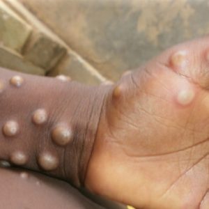 Mpox not as deadly as COVID-19, says WHO